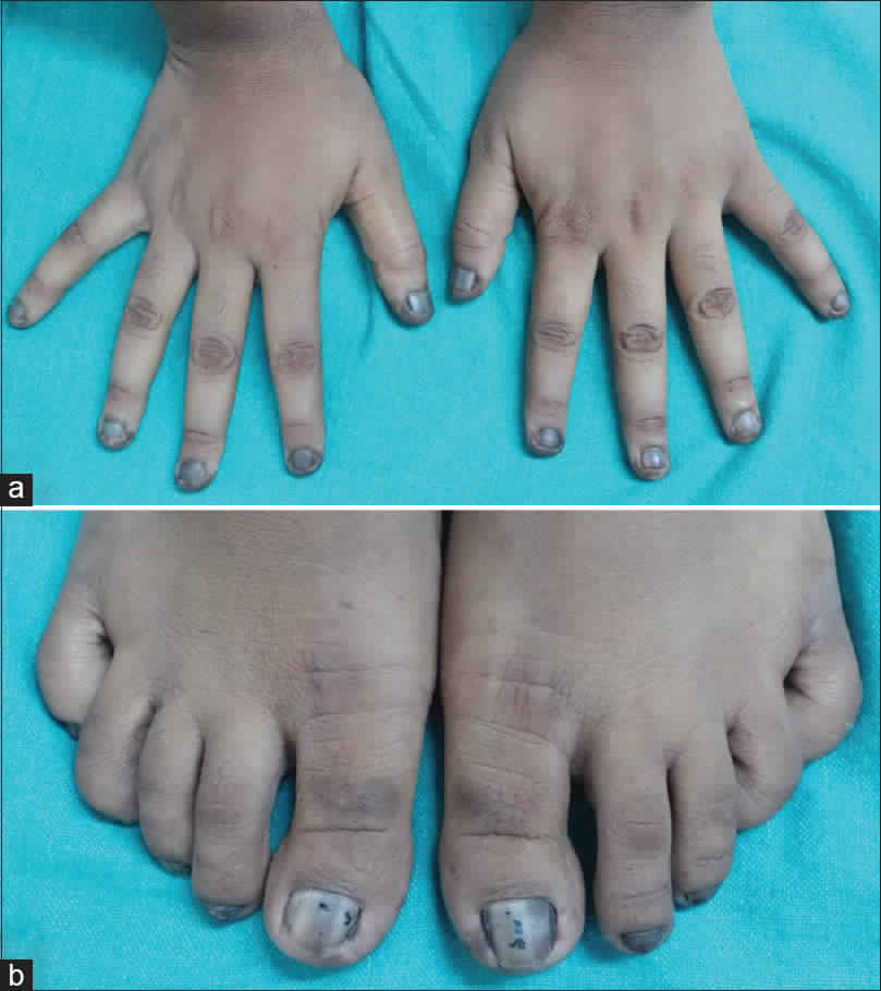 Cushing’s disease - Endodiab Clinic